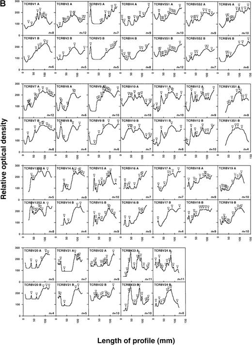 Fig. 3. Changes in the levels of T-cell oligoclonality following induction of HAART during primary HIV infection. / The level of oligoclonality was determined for each TCRBV family by using HMA, as described.28 (A) HMA gel hybridized with Cβb- and Cβc-carrier–specific probes showing variations in heteroduplex patterns for 26 TCRBV families and subfamilies in patient 1166, prior to and after initiation of HAART. (B) Computerized densitometric analysis of the HMA autoradiogram shown in panel A. Triangles indicate discrete TCRBV heterocomplexes detected over the HMA profiles with the use of automated peak discrimination as described in “Materials and methods.” TCRBV heterocomplex patterns prior to (TCRBV A) and after (TCRBV B) therapy for each β chain V-region family from patient 1166 are shown. The actual number of peaks detected appears in the bottom right corner. (C) Summary of clonality analysis in patients 1166, 1168, 1155, and 1192. Numbers of detectable clonotypes are shown prior to and after the introduction of HAART, while the decrease (closed boxes), stability (shaded boxes), or increase (open boxes) in the levels of oligoclonality of respective TCRBV families is indicated; nd indicates not done. Nomenclature of TCRBV families is according to Arden et al.31