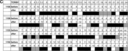 Fig. 3. Changes in the levels of T-cell oligoclonality following induction of HAART during primary HIV infection. / The level of oligoclonality was determined for each TCRBV family by using HMA, as described.28 (A) HMA gel hybridized with Cβb- and Cβc-carrier–specific probes showing variations in heteroduplex patterns for 26 TCRBV families and subfamilies in patient 1166, prior to and after initiation of HAART. (B) Computerized densitometric analysis of the HMA autoradiogram shown in panel A. Triangles indicate discrete TCRBV heterocomplexes detected over the HMA profiles with the use of automated peak discrimination as described in “Materials and methods.” TCRBV heterocomplex patterns prior to (TCRBV A) and after (TCRBV B) therapy for each β chain V-region family from patient 1166 are shown. The actual number of peaks detected appears in the bottom right corner. (C) Summary of clonality analysis in patients 1166, 1168, 1155, and 1192. Numbers of detectable clonotypes are shown prior to and after the introduction of HAART, while the decrease (closed boxes), stability (shaded boxes), or increase (open boxes) in the levels of oligoclonality of respective TCRBV families is indicated; nd indicates not done. Nomenclature of TCRBV families is according to Arden et al.31