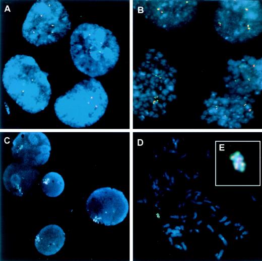 Fig. 7. FISH analysis of LAMA84 and LAMA84R cell lines. / (A) Interphase nuclei from LAMA84 displaying 2, 3, and 5 copies of the fused BCR/ABL signal indicating the BCR/ABL chimeric gene. (B) Metaphase spreads in the same cell line showing the modal number of 4 copies of BCR/ABL per cell. In contrast to the single fused signals observed in LAMA84, the resistant LAMA84R line additionally displayed an amplified signal containing multiple copies of BCR/ABL. (C) Interphase nuclei from LAMA84R showing the amplified signal plus single copies of the fused signal. (D) A metaphase sample of LAMA84R shows a similar signal compatible with the amplified element, shown at higher magnification in (E).