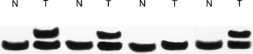 Fig. 1. Denaturing polyacrylamide gel analysis of theTβR-II gene in MSH2−/− murine lymphomas. / Examples of the analysis of DNA containing the mononucleotide (A) repeat from paired nonmalignant (N) and whole lymphoma tumor specimens (T). Slow migrating bands consistent with acquired frameshift insertion mutations are seen in the tumors in 3 of the 4 paired specimens.