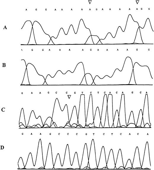 Fig. 2. Sequence analysis of the TβR-II gene inMSH2−/− murine lymphomas. / Examples of the genomic sequence profile of clones obtained from tumor DNA specimens demonstrating denaturing polyacrylamide gel band shifts in the region containing the mononucleotide (A) repeat (A and B) and in the region containing the (GT)3 repeat (C and D). (A) Mutant sequence with adenine insertion mutations (arrows), (B) corresponding wild type sequence, (C) mutant sequence with cytosine deletion mutation (arrow), (D) corresponding wild type sequence.