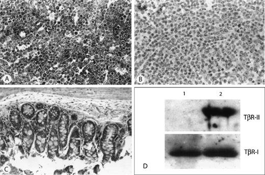 Fig. 4. Immunohistochemical and Western Blot detection of TβR-II protein. / (A) Example of a thymic lymphoma with wild-type TβR-II (A) repeat and detectable mRNA by RT-PCR. All tumor cells show strong immunohistochemical staining for TβR-II. (B) Example of a thymic lymphoma harboring an (A) repeat ID mutation, and showing no detectable mRNA by RT-PCR, demonstrates the absence of immunohistochemical staining for protein. (C) Nonmalignant tissue from the small intestine of the animal from panel B shows strong immunohistochemical staining for TβR-II. (D) Representative Western analysis of 2 murine lymphomas. Lane 1, lymphoma harboring TβR-II (A) repeat ID mutation; lane 2, lymphoma showing wild-type TβR-II (A) repeat. Top panel demonstrates absence of TβR-II protein in lane 1. Bottom panel is the same blot re-probed with an antibody to TβR-I as control.