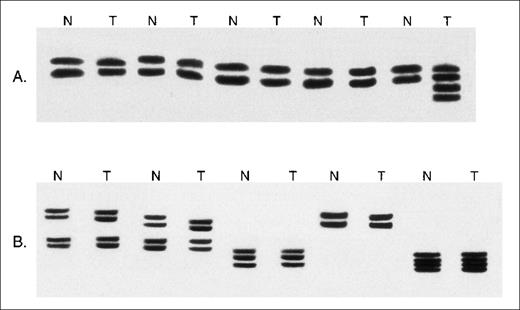 Fig. 5. Microsatellite analysis of MSH2−/− murine lymphomas. / (A) Examples of the analysis of DNA from paired nonmalignant (N) and whole lymphoma tumor specimens (T) at the D5Mit10 marker. Novel microsatellite alleles are present in 1 tumor specimen. (B) Examples of the analysis of DNA from paired normal tissue (N) and whole tumor tissue (T) at the D7Mit12 marker. No microsatellite instability is seen.