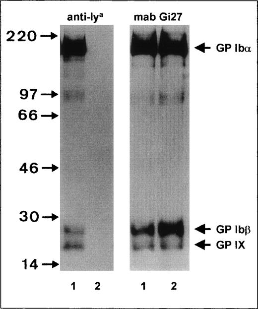Fig. 1. Immunoprecipitation analysis of the GPIb-Ibβ-IX complex of Iya-phenotyped platelets. / Platelets from Iya-positive (lane 1) and Iya-negative (lane 2) individuals were surface labeled with biotin, lysed, and immunoprecipitated with anti-Iya (left panel) and monoclonal antibody (MAB) Gi27 (right panel). Immunoprecipitates were analyzed with 7.5% sodium dodecyl sulfate-polyacrylamide gel electrophoresis (SDS-PAGE) under reducing conditions, transferred to nitrocellulose membrane, and visualized by using a streptavidin-horseradish peroxidase–chemiluminescence substrate system.