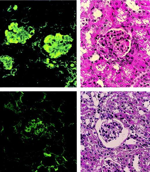 Fig. 5. Pathologic findings in glomeruli of MRL/lpr mouse kidneys. / A nontreated MRL/lpr mouse (20 weeks old) shows the proliferation of mesangial cells in the glomerulus (left, top) and marked IgG deposits (left, bottom). An MRL/lpr mouse (64 weeks old) treated with (5.5 Gy × 2 + PV + IV) shows normal appearance (right, top) without IgG deposits (right, bottom) 48 weeks after treatment.