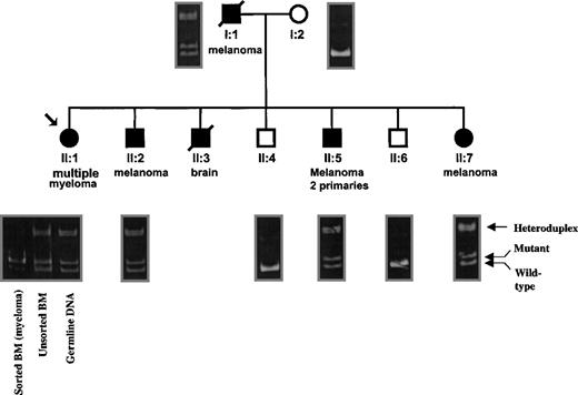 Fig. 1. The +24 base pair mutation cosegregates with melanoma and myeloma in family A, and the wild type allele is deleted in the malignant plasma cells of patient No. II:1. / Shaded members denote cancer development with the cancer type given below. The arrow indicates the proband with multiple myeloma. Four individuals in family A have developed melanoma (patients No. I:1, II:2, II:5, and II:7). The positions of the wild type, mutant, and heteroduplex bands are indicated on the right-hand side of the figure. Note that all 5 individuals harboring the +24 mutation have developed cancer, while patients No. I:2, II:4, and II:6 are wild type for both alleles and have not developed any malignancy. (DNA was not available for patient No. II:3.) On the left side of the figure, the PCR reactions from germline, unsorted BM, and sorted BM cells are shown under patient No. II:1. Note that the LOH of the wild typeCDKN2A allele is seen only in the sorted (greater than 90% malignant plasma cells) obtained from this individual. Importantly, there is a large decrease in the amount of heteroduplex DNA present in the sorted BM sample, which was again due to lack of the wild type PCR product.