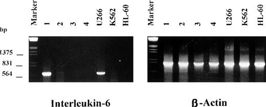 Fig. 3. Expression of interleukin 6 (IL-6) messenger RNA by myeloma cells with deletion of 13q14. / A strong band for IL-6 was observed in only 1 of 14 patients. U266 cells were included as positive controls; HL-60 and K562 cells were the negative controls.