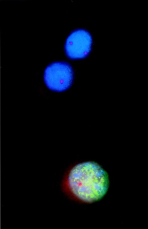 Fig. 1. Combined analysis using interphase fluorescence in situ hybridization (FISH) and bromodeoxyuridine (BrdU) incorporation to assess proliferative activity of cytogenetically defined cell populations. / Incorporated BrdU was detected with a fluorescein isothiocyanate-labeled monoclonal antibody that produced the green fluorescent pattern of the nucleus. A Spectrum Orange-tagged probe specific for the retinoblastoma gene-1 (rb-1) was used for FISH analysis. Thus, of the 2 rb-1–deleted myeloma cells, 1 cell incorporated BrdU, indicating DNA synthesis and proliferation.