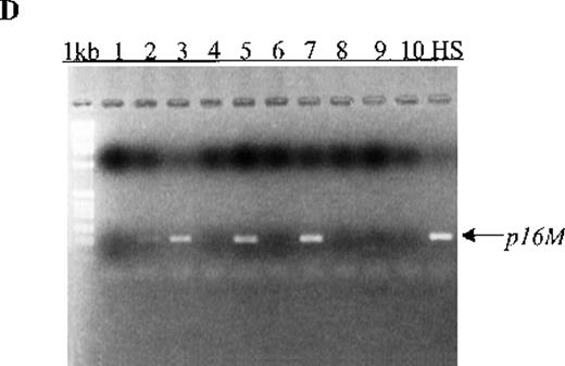 Fig. 1. Aberrant p15 methylation in adult and childhood acute leukemias. / (A) p15 methylation patterns in acute biphenotypic leukemia (ABL; lanes 1 and 2) and acute myeloid leukemia (AML; subtypes M1, M2, M3, M4, M5, M6, and M7 in lanes 3-24). DNA was amplified by using p15MF and p15MR primers. HS-Sultan DNA (HS) served as a methylated control. The 1-kilobase (kb) ladder is the molecular-weight standard. (B, C) Aberrantly methylated p15 sequences in blood plasma from patients with acute leukemia on ethidium bromide-stained agarose gels and Southern blots. Plasma DNA samples from patients withoutp15 methylation in blood cells or bone marrow are shown in lanes 1 to 4; samples from patients with p15 methylation in blood cells or bone marrow are shown in lanes 5 to 10. (D) p16methylation status in patients with AML (lanes 1-5) and acute lymphoblastic leukemia (ALL; lanes 6-10). DNA was amplified by using p16MF and p16MR primers.