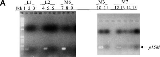 Fig. 3. Sequential monitoring of p15 methylation status in peripheral blood from patients with acute leukemia. / (A, B) Results on ethidium bromide-stained agarose gels and Southern blots for patients with L1, L2, M6, M3, and M7 subtypes at diagnosis (lanes 1, 4, 7, 10, and 12) or morphologic remission. The adult with the M6 subtype in whom active leukemia developed had methylatedp15 sequences (panel B, lane 9). The child with the M7 subtype had persistent unmethylated p15 status largely associated with morphologic remission and lack of residual leukemia for 3 months (lanes 13-15). (C, D) Results on agarose gels and Southern blots for patients with M2, ABL, and M4 subtypes at morphologic relapse, during active leukemia or residual leukemia, or in remission. HS-Sultan DNA (HS) served as a methylated control. The 1-kb ladder is the molecular-weight standard. The adult with M2 subtype had p15 methylation at diagnosis and relapse (lanes 1-2). The adult with ABL had p15methylation in association with morphologic relapse (lane 7) and the subsequent stage of active leukemia. p15 methylation was detected at morphologic remission in the adult with M4 subtype, who had relapse 2 weeks later (lanes 9-10).