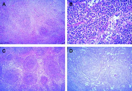 Fig. 1. Marginal zone B-cell lymphoma. / (A) Nodal peri- and interfollicular infiltration by monocytoid B-cells with clear cytoplasm (HE × 60). (B) Nodal perisinusoidal infiltration by small tumoral B-cells with plasmacytic differentiation (HE × 400). (C) Splenic perifollicular infiltration surrounding the residual white pulp follicles, with typical “marginal-zone” pattern (HE × 60). (D) Splenic nodular infiltration with colonization of the white pulp by the tumoral cells associated with a diffuse invasion of the sinuses in the red pulp (HE × 60).