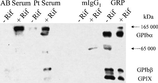 Fig. 2. Immunoprecipitation of the GPIb-IX complex using the rifampicin-dependent antibodies. / After labeling the surface proteins of the platelets with biotin, the GPIb-IX complex was immunoprecipitated using AB serum, patient serum, a nonspecific murine IgG1 (MOPC21), and the GPIX-specific mAb (GRP), all in the presence or absence of the drug as indicated. The platelets were lysed, and the immunoprecipitated proteins were collected using Dynabeads coated with the appropriate capture antibodies. The proteins were analyzed by SDS-PAGE, transferred to PVDF membrane, and detected by streptavidin HRP and chemiluminescence reagents. The GPIb-IX complex (GPIbα, 143-kd band; GPIbβ, 24-kd band; and GPIX, 20-kd band) was only detected with the patient serum in the presence of the drug (lane 4) and with the anti-GPIX mAb (GRP) in both the absence (lane 7) and presence (lane 8) of the drug. Nonspecific bands (165 kd and 65 kd) were seen both with the test, and control antibodies in the presence or absence of the drug and were present in no particular pattern.
