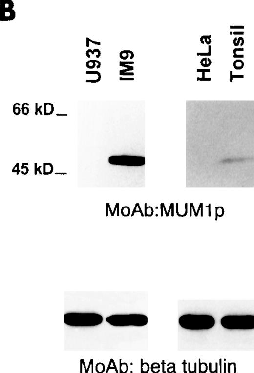 Fig. 1. Western blotting with the MUM1p monoclonal antibody. / (A) A band of 52-kd of the expected size of the MUM1-HA protein is seen in line corresponding to pHeBo-CMV-MUM1-HA HeLa-transfected cells but not in negative control HeLa cells. (B) A 50-kd band of the expected molecular size of the MUM1 protein is seen in lanes 2 and 4, corresponding to the IM9 myeloma cell line and normal tonsil. No bands are detected in lanes 1 and 3, corresponding to U937 and HeLa cell lines. Identical results (not shown) were obtained with the monoclonal (clone MUM97) and polyclonal anti-IRF4/ICSAT antibody. In both experiments, β tubulin levels are shown below to control for the integrity and amount of the loaded protein.