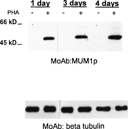 Fig. 5. MUM1 expression in normal activated T cells. / A 50-kd band of the expected molecular size of the MUM1 protein is seen in lanes (+) corresponding to PHA-stimulated peripheral blood T cells (at days 1, 3, 4), whereas no band is observed in lanes (−) corresponding to T cells under basal conditions (Western blotting with the MUM1p monoclonal antibody). β Tubulin levels are shown below to control for the amounts of the loaded protein.