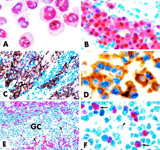 Fig. 2. MUM1 expression in myeloma cell line and normal lymphoid tissues. / (A) IM9 human myeloma cell line. Microgranular positivity for the MUM1 protein is observed in the nucleus (stronger) and in the cytoplasm (weaker) of tumor cells. Arrowheads indicate negative nucleoli (APAAP; × 1000). (B) MUM1 protein expression in the nucleus (stronger) and in the cytoplasm (weaker) of plasma cells in a lymph node involved by a plasmacellular variant of Castleman disease (paraffin section; APAAP; × 800). (C) Paraffin section from normal tonsil double stained for cytokeratins (tonsil epithelium labeled in brown) and MUM1 (plasma cells labeled in blue) (APAAP; × 250). (D) All plasma cells in the tonsil epithelium double stain for intracytoplasmic light chains (brown) and nuclear MUM1 (blue) (× 1000). (E) Isolated or small clusters of MUM1+ cells (arrowheads) are present within GC (APAAP; × 250). (F) At higher magnification, some of the MUM1+ cells in the GC show a markedly irregular (often multilobated) nucleus (arrows). Arrowhead points to a MUM1− macrophage (APAAP; × 1000). (A-F) Immunostaining with MUM1p monoclonal antibody; hematoxylin counterstain.