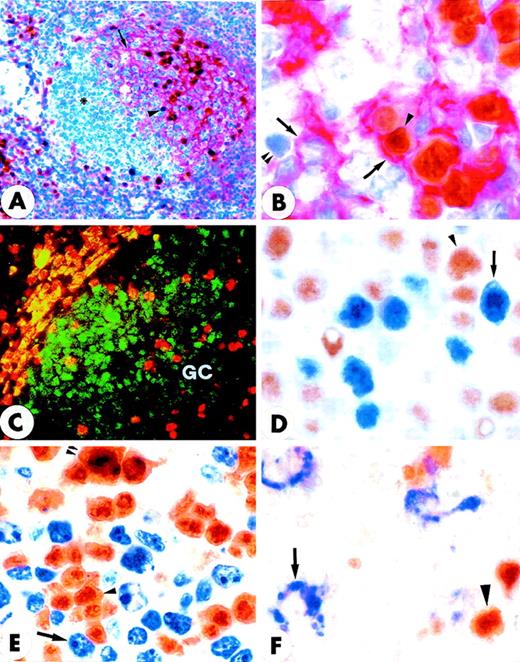 Fig. 3. Double-stained GC of normal tonsil (paraffin sections). / (A) Double staining for MUM1 (brown) and CD23 (red) shows that GC MUM1+ cells (arrowhead) are located in the light zone in close association with CD23+ follicular dendritic reticulum cells (arrow). Asterisk indicates negative centroblasts in the dark zone (× 250; hematoxylin counterstain). (B) The intimate contact of brown MUM1+ cells (arrowhead) with red CD23+follicular dendritic cells (arrow) is shown at higher magnification (× 1000). Double arrowheads indicate a MUM1−/CD23− GC cell. (C) Expression of MUM1 (red) and Bcl-6 (green) are mutually exclusive within the GC of tonsil (double immunofluorescence; × 800). (D) Expression for brown nuclear Bcl-6 (arrowhead) and blue nuclear MUM1 (arrow) in GC B-cells appears to be mutually exclusive (× 1000; no counterstain). (E) Expression for brown nuclear MUM1 protein (arrowhead) and blue Ki67 proliferation antigen (arrow) appears to be mutually exclusive, with the exception of rare cells (double arrowheads) that double stain for the 2 antigens (× 1000; no counterstain). (F) The MUM1 protein (brown) and the CD68 antigen (blue) are clearly expressed in different cell types. The arrow points to a CD68+ tingible body macrophage, whereas the arrowhead indicates a MUM1+ GC cell (× 1000; no counterstain). (A-F) Biotin-avidin peroxidase/APAAP.