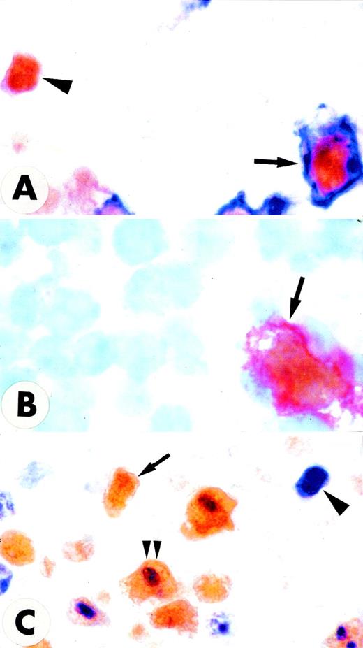Fig. 4. Double stainings in the interfollicular area of normal tonsil. / (A,C) Paraffin sections. (B) Frozen section. (A) A large cell coexpressing surface CD30 (blue) and nuclear MUM1 (brown) is indicated by the arrow; a MUM1+/CD30− small cell is also observed (arrowhead) (× 1000; no counterstain). (B) A large cell coexpressing surface CD30 (red) and nuclear MUM1 (brown) is indicated by the arrow (× 1000; hematoxylin counterstain). (C) Many large cells in the area adjacent to the follicle mantle (most likely CD30+ cells) coexpress the proliferation antigen Ki67 (blue labeling of nucleoli) and the brown nuclear MUM1 protein (double arrowheads). Arrowhead indicates a Ki67+/MUM1− cell. Arrow indicates a Ki67−/MUM1+ cell (× 800 ; no counterstain).