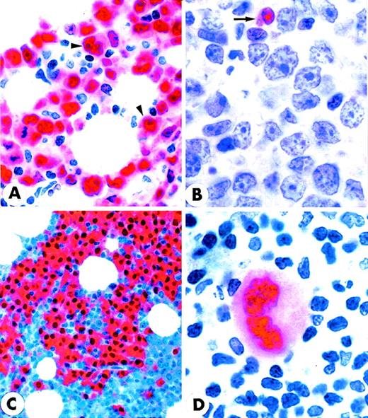 Fig. 6. MUM1 expression in lymphomas and myeloma. / (A) Diffuse, large B-cell lymphoma showing nuclear and cytoplasmic positivity for the MUM1 protein. Arrowheads point to large MUM1+ tumor cells with prominent nucleoli (lymph node paraffin section; × 800). (B) Diffuse, large B-cell lymphoma showing no expression of the MUM1 protein. The arrow points to a normal residual MUM1+ cell (lymph node paraffin section; × 1000). (C) Multiple myeloma showing strong nuclear and cytoplasmic positivity of tumor cells for the MUM1 protein (paraffin section from bone marrow trephine biopsy; × 250). (D) Strong nuclear and weak cytoplasmic expression of the MUM1 protein in a Reed–Sternberg cell of Hodgkin's disease, nodular sclerosing type (lymph node paraffin section; × 1000). (A-D) Immunostaining with the MUM1p monoclonal antibody; APAAP procedure; hematoxylin counterstain.