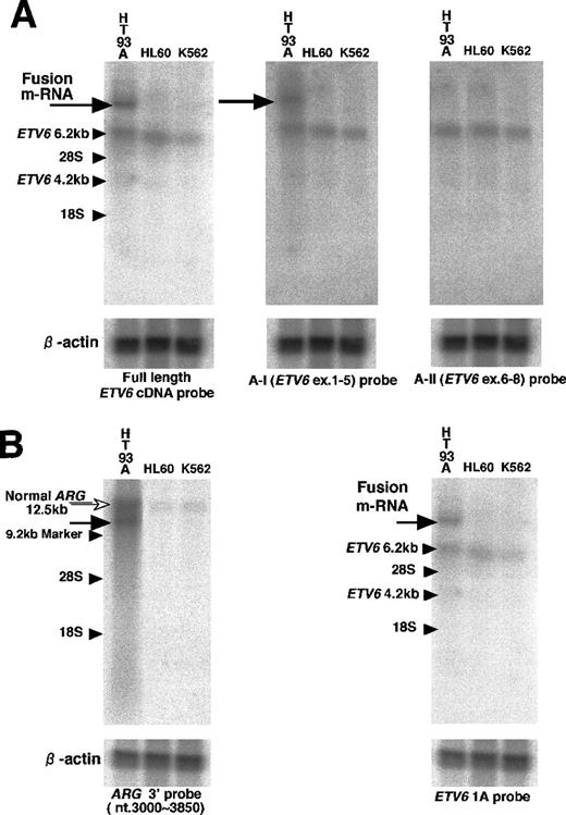 Fig. 4. Northern hybridization. / (A) The first hybridization. With full length ETV6 cDNA probe, 6.2 kb transcript (small arrow) was detected in the HT93A, HL60, and K562 cells, but an additional longer transcript (large arrow) was detected only in the HT93A cells. This abnormal transcript was hybridized with A-I (ETV6 exons 1-5) probe but not with A-II (ETV6 exons 6-8) probe. (B) The second hybridization. With theARG 3′ probe, an abnormal transcript (black arrow) was detected only in the HT93A cells at the same position as the abnormalETV6 transcript in the first hybridization. The 12.5 kb normal transcript of ARG (white arrow) was also detected in HT93A cells and control cells. This abnormal band was hybridized only withETV6 exon 1A probe.