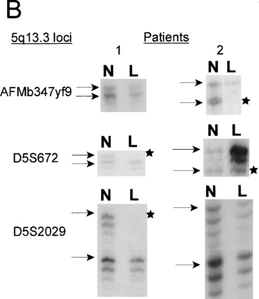 Fig. 2. A. Delineation of the critical region of loss between in patients 1 and 2. / Marker D5S2634 maps within 30-kb of marker D5S672 (SHGC radiation hybrid map) and is placed centromeric, based on results from our somatic cell hybrid. The ordering of markers is supported by the YAC contig in Figure 3. B. Loss of heterozygosity analysis of polymorphic markers at 5q13.3. Paired samples of DNA from peripheral blood granulocytes or bone marrow blasts and mononuclear cells were PCR amplified for each of the 5q13.3 polymorphic markers. Patient 1 mononuclear cells were short term cultured to select for the leukemic population. The presence of 2 alleles in the control sample rendered a given patient informative for the specific locus. N = normal sample. L = leukemic sample. Arrows mark the location of alleles. Stars indicate allele loss.