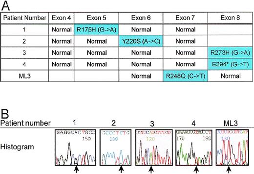 Fig. 5. A. Mutations in remaining allele of TP53. / Exons 4 through 8 of the TP53 gene were amplified by PCR using intronic primers and sequenced to identify mutations. Patients 1, 2, 3, 4, and ML3 each had a mutation in the coding region of the gene. B. Histograms of mutant TP53 alleles from patients. Point mutations are designated by arrows.