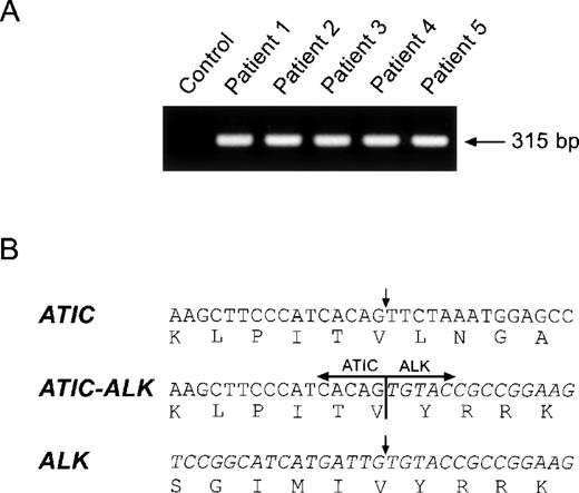 Fig. 3. (A) ATIC-ALK RT-PCR analysis and (B) cDNA fusion junction. / (A) Total RNA prepared from the tumor specimens of 5 ALCL patients was examined by ATIC-ALK RT-PCR; all cases expressed the expected 315-bp ATIC-ALK product. Total RNA prepared from theNPM-ALK-positive ALCL cell line SUP-M2 was used as a negative control. (B) ATIC-ALK fusion cDNA sequences were identical in each of the 5 lymphomas tested.