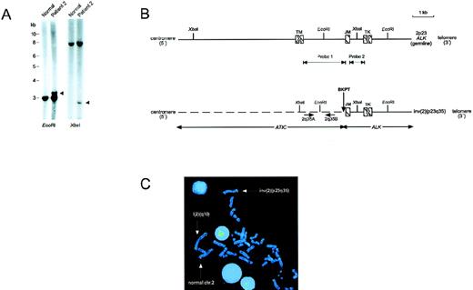 Fig. 1. Genomic cloning of inv(2)(p23q35). / (A) Southern blot hybridization of ALCL tumor DNA from patient 2 usingALK probe 2 (see panel B), demonstrating rearranged restriction fragments (arrowheads). (B) Schematic of a portion of the germlineALK locus, and of the chimeric genomic fragment generated by the inv(2)(p23q35). The exact sizes of the exons encoding the transmembrane (TM) and tyrosine kinase (TK) domains of ALK have not been determined, and are therefore shown as interrupted cross-hatched boxes. The position of the inv(2) genomic breakpoint in the tumor of patient 2 is illustrated. The genomic location of ATIC exons was not determined; however, no exons were identified by sequencing of the approximately 2.0-kb segment of the ATIC locus extending from the XbaI restriction site to the breakpoint location. The location of the primer pair (2q35A, 2q35B) from the 2q35 gene locus used to identify clones PAC213D24 and PAC218E3 by PCR-based library screening is shown. JM, ALK juxtamembrane-encoding exon. (C) FISH analysis of inv(2). FISH of a metaphase chromosome spread from the inv(2)-positive ALCL tumor of patient 1 with PAC213D24, demonstrating its localization to 2q35 on the normal chromosome 2 and i(2)(q10) (which is a secondary chromosomal abnormality seen in inv(2)-positive cases that is formed by the joining of 2 long arms produced by the inversion11), and splitting of the clone by the inv(2)(p23q35).