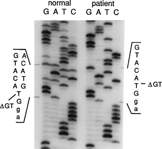 Fig. 2. Sequence analysis of the intron 1/exon 2 border of thep47-phox gene. / Genomic DNA derived from a normal donor and an A47° CGD patient was amplified using primers 2LA, 2LB, 2RC, and 2RD. The PCR product contained the 3′ end of intron 1 (small letters) and the 5′ end of exon 2 (capital letters). The position of the GT deletion is marked as ΔGT.
