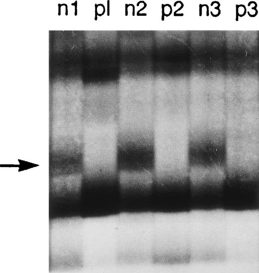 Fig. 4. SSCP of PCR amplified genomic DNA strands of exon 2. / SSCP was performed on genomic DNA samples from normal donors (n1, n2, and n3) and A47° CGD patients (p1, p2, and p3) using the nested primer pairs 2LA/2LB and 2RC/2RD. The amplification products containing the 3′ end of intron 1 and the 5′ end of exon 2 were electrophoresed on a nondenaturing polyacrylamide gel. The figure shows a typical SSCP analysis, where the diagnostic band (−>) was missing in all patients carrying ΔGT.