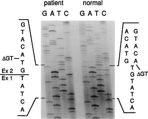 Fig. 5. Sequence analysis of the exon 1/exon 2 border of p47-phox. / cDNA from an A47° CGD patient and a normal donor was PCR amplified and sequenced. The position of the GT deletion is marked as ΔGT.