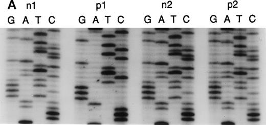 Fig. 7. Sequence analysis of the 5′ region of intron 2. / (A) Genomic DNA from healthy individuals (n1 and n2) and A47° CGD patients (p1 and p2) was amplified using the primers 2LA, 2LB, 2RA, and 2RB. The PCR product of the pseudogene contained the 20-bp duplication located 176-bp downstream of the 5′ end of intron 2. Patient p1 had only the 20-bp duplication characteristic for the pseudogenes, whereas patient p2 and healthy individuals showed both the single 20-bp sequence of the wild-type gene and the 20-bp duplication, as indicated by 2 overlying sequences in intron 2. (B) Direct sequence analysis of fragments amplified across the 5′ region of intron 2 using the above primers and directly subcloned into pTA (Invitrogen). Sequence analysis used the reverse primer, and the orientation of the nucleotides is T, G, C, and A across the 4 lanes for each reaction. The DNA template for PCR was normal genomic DNA, and individual clones were analyzed in lanes 1, 2, 4, 5, and 6. Lane 3 represents a 1:1 mixing of the clones sequenced in lanes 1 and 4. Lanes 1 and 2 demonstrate the wild-type sequence, which includes only 1 copy of the 20-bp repeat unit CAGGGTCTTGCTCTGTCACC, whereas lanes 4, 5, and 6 show the repeat (indicated by brackets).