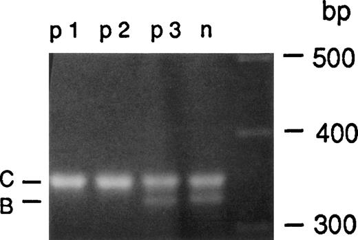 Fig. 8. PCR amplification of intron 2. / Genomic DNA from a healthy individual (n1) and 3 A47° CGD patients (p1, p2, and p3) was amplified using primers 2LB and 2RC. A 330-bp amplification product containing the single bp sequence 176-bp downstream from the 5′ end of intron 2 (B) as well as a 350-bp fragment containing the 20-bp duplicated sequence from the pseudogene (C) were detected in normal individuals. Only the 350-bp fragment indicative for the pseudogene sequence was amplified from patients p1 and p2, whereas patient p3 showed both the 330- and 350-bp PCR product indicating the presence of wild-type and pseudogene alleles.