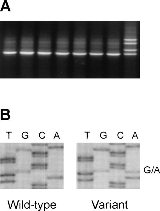 Figure 1. 
 Detection of the V410I (G1228A) variant of the caspase-10 gene in DNA from healthy blood donors. / (A) Representative denaturing gradient gel electrophoresis (DGGE)analysis of a region encompassing nucleotides 1186-1322 (codons 396-441) of the caspase-10 gene. (B) Direct sequence analysis of a sample with aberrant DGGE pattern, showing the G1228A variant.