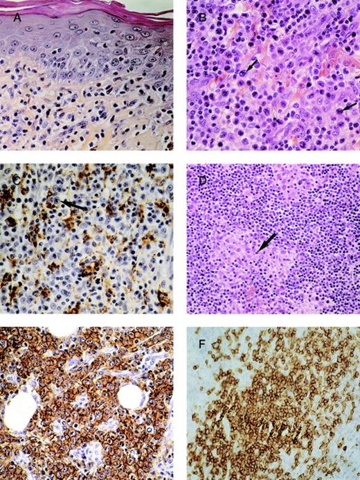 Fig. 1. Histopathologic and immunohistochemical features. / (A) Mycosis fungoides before transformation: proliferation of small-sized lymphocytes in the upper dermis with epidermotropism. (B) The same case after transformation: the lymphoid infiltrate has become tumoral and polymorphous with more than 25% of large-sized lymphocytes (arrows). (C) Analysis of percentage of large lymphomatous cells (cytologic transformation) after CD68 immunostaining: between histiocytic components (CD68 positive cells), large lymphomatous cells (arrows) are CD68 negative. (D) The main differential diagnosis of transformed-MF: “histiocytic-rich” or granulomatous MF. Note that the lymphocytes between histiocytic granulomas (arrows) remain small. (E) Immunostaining with the Ber-H2 antibody in a case of transformed-MF: CD30 expression by more than 75% of large cells. (F) Immunostaining with the CD20 antibody (anti-B lymphocytes): nodular infiltrate of CD20-positive lymphocytes.