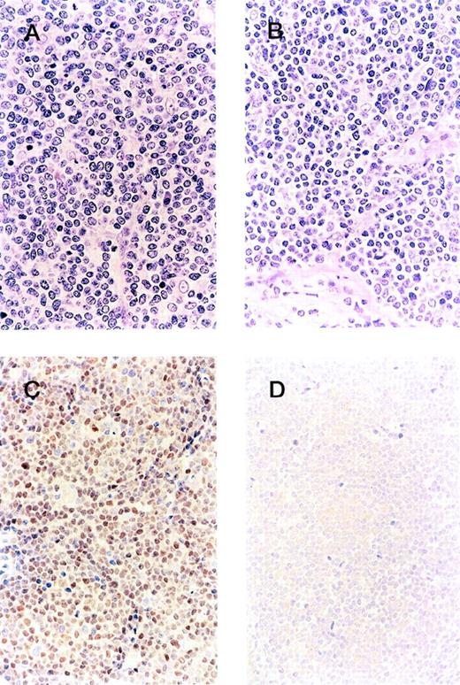 Fig. 1. Clinicopathologic boundary of mantle cell lymphoma. Although the morphology of the cyclin D1-positive group (A) and -negative group (B) is indistinguishable, the patient from the former group shows cyclin D1 overexpression (C), whereas the latter is negative for cyclin D1 (D).