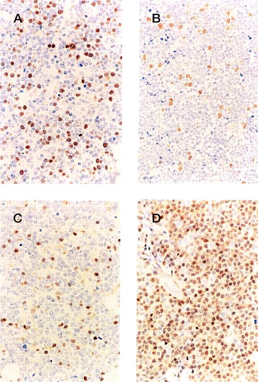 Fig. 2. Immunohistochemistry of cell cycle regulators. The labeling index of phosphorylated pRb is low for both the cyclin D1-positive (A) and -negative (B) groups, but the expression ofp27KIP1 in the cyclin D1-positive MCL (C) is lower than in the cyclin D1-negative group (D).