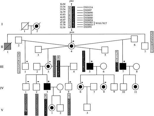 Fig. 1. Pedigree and haplotypes of the family with XLTT. / Although individual II-1 was not examined, his history of bleeding and bruising with minimal trauma strongly suggest that he was affected. The portion of the chromosome containing the XLTT gene is shown in black. Previously, α:β globin chain ratios were studied in some members. Individuals in whom an altered hemoglobin chain ratio was detected are denoted by a + sign, and individuals with a normal ratio are denoted by a − sign.