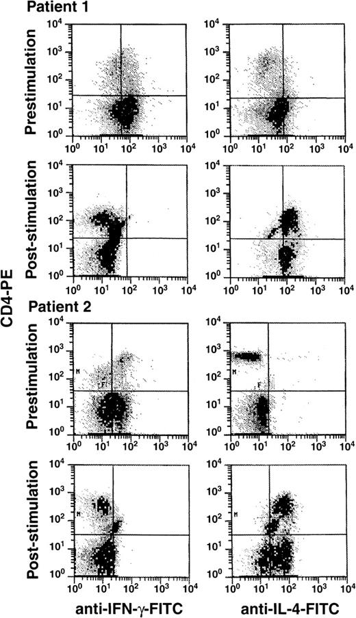 Fig. 1. Effects of G-CSF administration on IFN-γ and IL-4 production by peripheral blood lymphocytes. / Eleven normal stem cell donors received G-CSF (10 μg/kg per day) for 5 days. Blood was obtained before and after the administration of G-CSF. PBMC cells were purified by density-gradient centrifugation and were cultured with PHA for 48 hours. After permeabilization, cells were stained for IFN-γ and IL-4 as described in “Materials and methods.” Scattergrams represent log PE (CD4 or CD8) fluorescence activity versus log FITC (IFN-γ and IL-4) fluorescence activity for representative donors (A, B).
