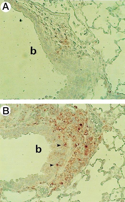 Fig. 6. Distribution of MHC II positive dendritic cells (DCs) and macrophages in the lung. / Mice were killed 12 days after intrapulmonary injection of adenoviral gene vector expressing murine granulocyte-macrophage colony-stimulating factor (AdGM-CSF), Addl70-3, or phosphate-buffered saline. Lung tissues were isolated and fixed in 10% formalin and 3-cm sections were immunostained with monoclonal anti-MHC II M5 antibody and 50% hematoxylin counterstaining. (A) Addl70-3 control vector treatment; (B) AdGM-CSF treatment. Many MHC II-positive cells are seen in Figure 6B, some intraepithelial DC are marked with arrowheads. Bronchial lumen is marked by b. (Magnification for both panels is 450.)