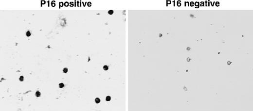 Fig. 3. Immunocytochemical determination of p16(INK4A) expression in sorted bone marrow stem cells. / Adult ALL bone marrow was sorted as described in “Materials and methods.” Sorted stem cells (CD34+lin−) were collected on slides and stained for p16(INK4A) expression. The slide images were captured using an inverted microscope at 125× magnification. The images were transferred to a computer using a frame grabber board (Target+; Truevision) and stored in computer files using Java image analysis software (Jandel Scientific, Corte Madona, CA). Left panel: sorted CD34+lin− cells from a p16(INK4A)-positive ALL bone marrow. Note positive nuclear localization. Right panel: sorted CD34+lin− cells from a p16(INK4A)-negative ALL bone marrow. Nuclei are unstained.