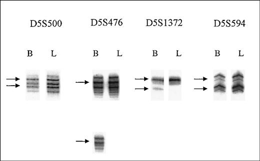 Fig. 2. PCR amplification patterns for critical markers in case 24. / Marker names indicated on the top of the figure are shown in order from telomere (left) to centromere (right). PCR analysis is shown for DNA isolated from normal buccal smear (B) compared with DNA from leukemia cells (L) isolated from the patient's bone marrow sample. For each marker, the 2 alleles in the buccal DNA are indicated by arrows. Markers D5S500 and D5S594 show retention of both alleles in the leukemia sample, whereas loss of 1 allele is apparent for markers D5S476 and D5S1372.