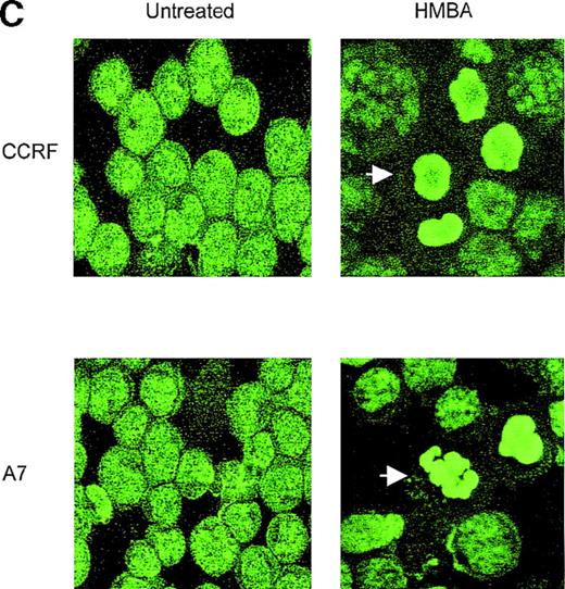 Fig. 3. Hexamethylene bisacetamide (HMBA)-induced nuclear damage indicative of apoptosis. / (A) CCRF and A7 CEM cells were untreated or cultured for 48 hours with 10 mmol/L HMBA or for 4 hours with 100 ng/mL anti-Fas antibody (CH-11). Genomic DNA was extracted and run on a 2% agarose gel. CCRF and A7 CEM cells were treated for 48 hours with 10 mmol/L HMBA and assayed by TUNEL for DNA fragmentation as denoted by an increase in mean channel fluorescence (B) and Hoechst 33 258 staining (C) for chromatin condensation. The percentage of TUNEL-positive cells are shown above each histogram, and cells displaying chromatin condensation are indicated by an arrow. Lysates from CCRF and A7 cells treated for 72 hours with 0-20 mmol/L HMBA were separated by SDS-PAGE, and Western blots were performed using polyclonal anti-PARP antibody (D). The active form of PARP migrates as a 118-kD protein and cleaved to an inactive form of approximately 89 kd.