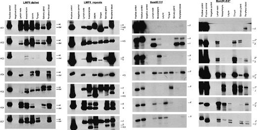 Fig. 1. Genotype identification of EBV. / Direct PCR analysis was used to determine the genotype identification of EBV of several different polymorphic loci of the EBV genome in peripheral blood mononuclear cells (PBMCs) and multiple lymphoid and epithelial tissues obtained at different anatomic sites of the normal individual viral carriers (VC1-7). Multiple viral strains were detected at different tissues and PBMCs within individual viral carriers. Considerable variability in amplification of viral strains was also noted at different anatomic sites within the same person. Coresident viruses were designated as distinct strains when PCR analysis detected either (i) both type 1 and 2 viruses or (ii) mixed infection of both deletion and wild-type LMP1 variants or (iii) mixed infection of both BamHI F and f.