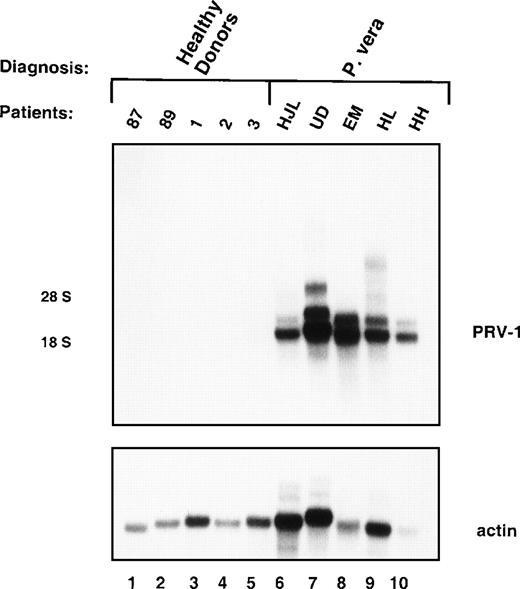 Fig. 1. Expression of PRV-1 in peripheral blood granulocytes from patients with PV and normal controls. / Granulocytes were isolated from peripheral blood to more than 98% purity. Total RNA was extracted and a Northern blot prepared using 10 μg RNA. Lanes 1-5 healthy volunteer donors, lanes 6-10 patients with PV. (Top) The membrane was probed with a 1.1-kb fragment of the PRV-1 cDNA. The positions of the 18S and 28S ribosomal RNAs are indicated. (Bottom) The membrane was stripped and reprobed with a 1.2-kb fragment of the human β-actin cDNA.