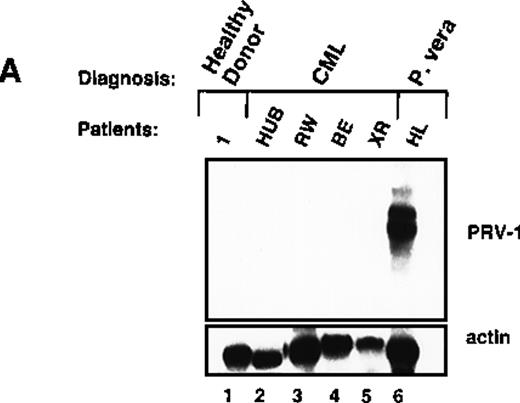 Fig. 5. Expression of PRV-1 in other MPDs. / Mononuclear cells were isolated from peripheral blood of patients with CML (A) or AML (D). Granulocytes were isolated from peripheral blood of patients with ET (B), IMF (C), secondary erythrocytosis (E), PV (A, B, D, and E) or healthy volunteers (A and D). Total RNA was extracted and Northern blots prepared using 10 μg RNA. (Top) The membrane was probed with a 1.1-kb fragment of the PRV-1 cDNA. (Bottom) The membrane was stripped and reprobed with a 1.2-kb fragment of the human β-actin cDNA.