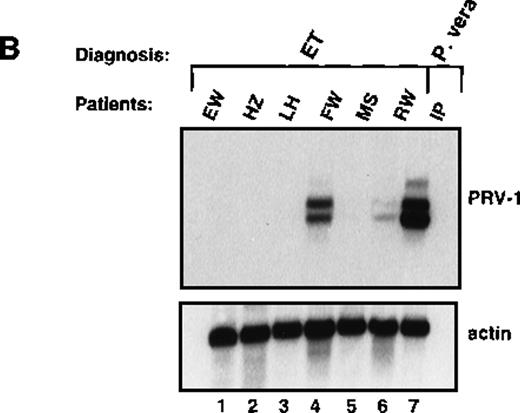 Fig. 5. Expression of PRV-1 in other MPDs. / Mononuclear cells were isolated from peripheral blood of patients with CML (A) or AML (D). Granulocytes were isolated from peripheral blood of patients with ET (B), IMF (C), secondary erythrocytosis (E), PV (A, B, D, and E) or healthy volunteers (A and D). Total RNA was extracted and Northern blots prepared using 10 μg RNA. (Top) The membrane was probed with a 1.1-kb fragment of the PRV-1 cDNA. (Bottom) The membrane was stripped and reprobed with a 1.2-kb fragment of the human β-actin cDNA.