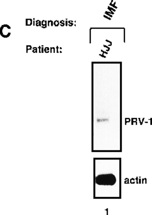 Fig. 5. Expression of PRV-1 in other MPDs. / Mononuclear cells were isolated from peripheral blood of patients with CML (A) or AML (D). Granulocytes were isolated from peripheral blood of patients with ET (B), IMF (C), secondary erythrocytosis (E), PV (A, B, D, and E) or healthy volunteers (A and D). Total RNA was extracted and Northern blots prepared using 10 μg RNA. (Top) The membrane was probed with a 1.1-kb fragment of the PRV-1 cDNA. (Bottom) The membrane was stripped and reprobed with a 1.2-kb fragment of the human β-actin cDNA.