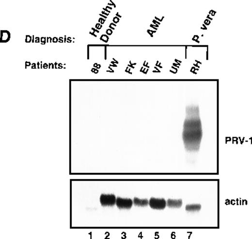 Fig. 5. Expression of PRV-1 in other MPDs. / Mononuclear cells were isolated from peripheral blood of patients with CML (A) or AML (D). Granulocytes were isolated from peripheral blood of patients with ET (B), IMF (C), secondary erythrocytosis (E), PV (A, B, D, and E) or healthy volunteers (A and D). Total RNA was extracted and Northern blots prepared using 10 μg RNA. (Top) The membrane was probed with a 1.1-kb fragment of the PRV-1 cDNA. (Bottom) The membrane was stripped and reprobed with a 1.2-kb fragment of the human β-actin cDNA.