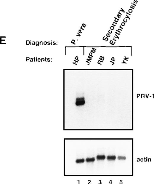 Fig. 5. Expression of PRV-1 in other MPDs. / Mononuclear cells were isolated from peripheral blood of patients with CML (A) or AML (D). Granulocytes were isolated from peripheral blood of patients with ET (B), IMF (C), secondary erythrocytosis (E), PV (A, B, D, and E) or healthy volunteers (A and D). Total RNA was extracted and Northern blots prepared using 10 μg RNA. (Top) The membrane was probed with a 1.1-kb fragment of the PRV-1 cDNA. (Bottom) The membrane was stripped and reprobed with a 1.2-kb fragment of the human β-actin cDNA.