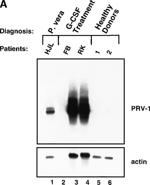 Fig. 8. Expression of PRV-1 in granulocytes from healthy volunteers treated with G-CSF in vivo and in vitro. / Granulocytes were isolated from peripheral blood of untreated and G-CSF-treated healthy volunteers and a patient with PV. Total RNA was extracted and a Northern blot prepared using 10 μg RNA. (A) Lane 1 patient with PV, lane 2 empty, lanes 3 and 4 healthy volunteers treated with G-CSF in vivo, and lanes 5 and 6 untreated healthy volunteer donors. (B) Lane 1 unstimulated granulocytes; lanes 2-8, granulocytes stimulated in vitro for the indicated times with 100 ng/mL G-CSF. (Top) The membrane was probed with a 1.1-kb fragment of the PRV-1 cDNA. (Bottom) The membrane was stripped and reprobed with a 1.2 kb fragment of the human β-actin cDNA.